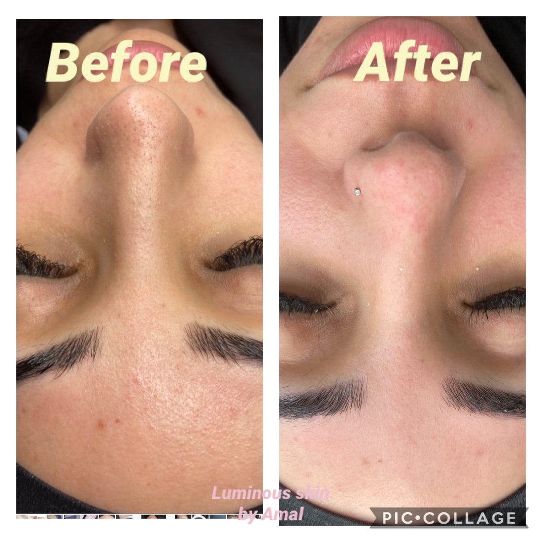 Carboxy Korean Facial plus HYDRA deep clean &amp; Led Light