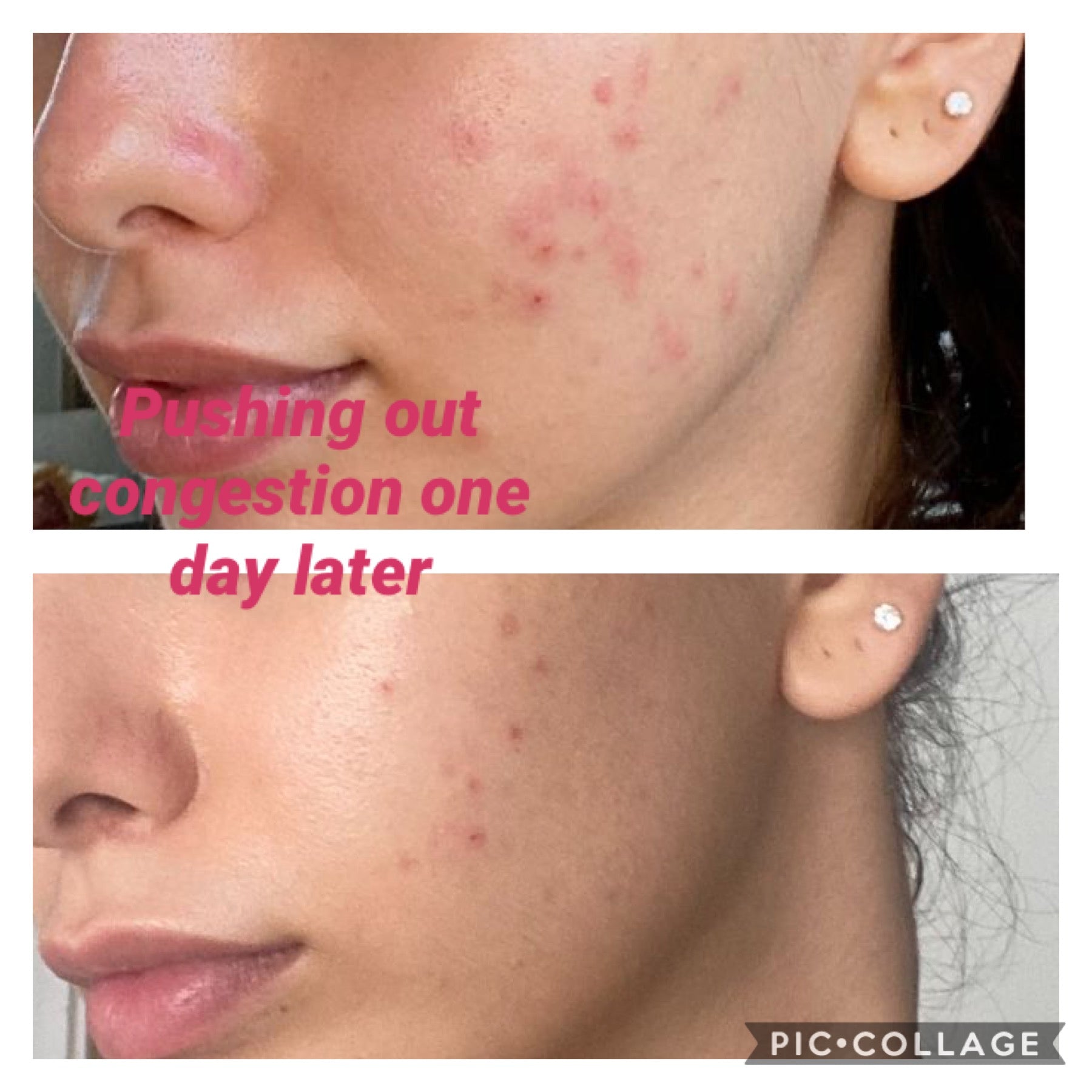 Carboxy Korean Facial plus HYDRA deep clean &amp; Led Light