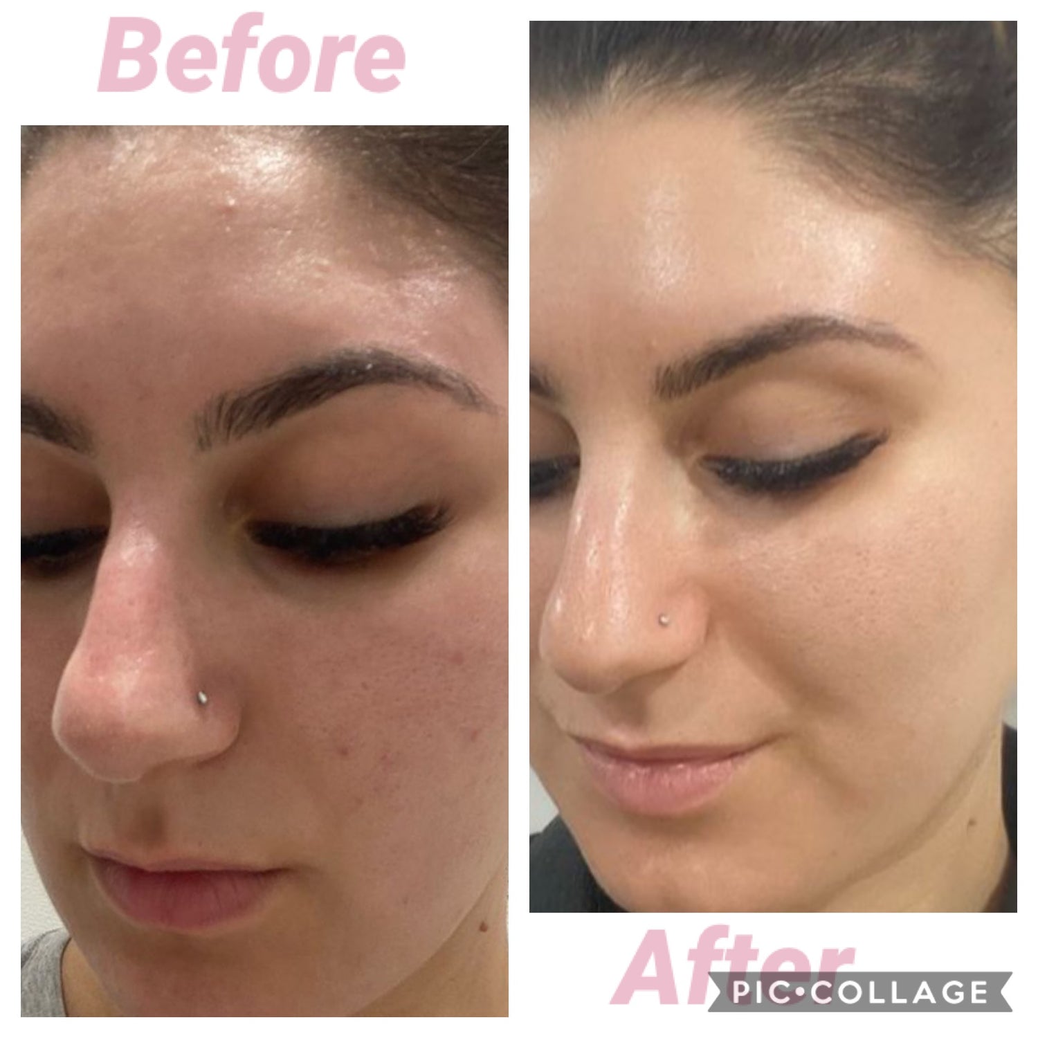 Carboxy Korean Facial plus HYDRA deep clean &amp; Led Light
