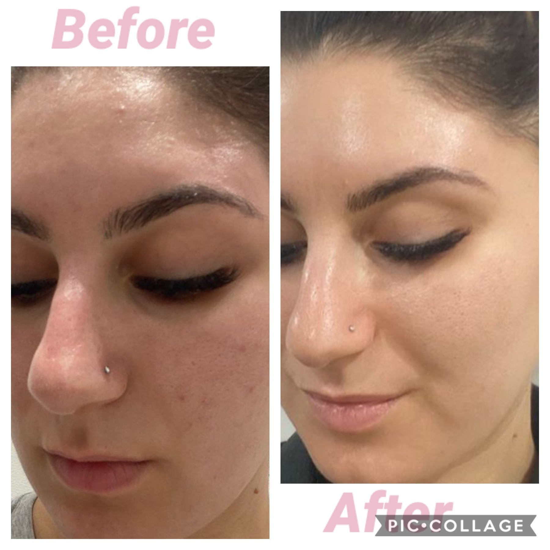 Carboxy Korean Facial plus HYDRA deep clean &amp; Led Light