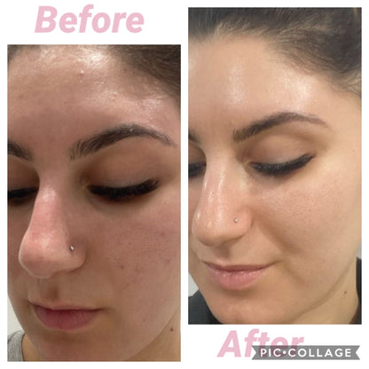 Carboxy Korean Facial plus HYDRA deep clean &amp; Led Light