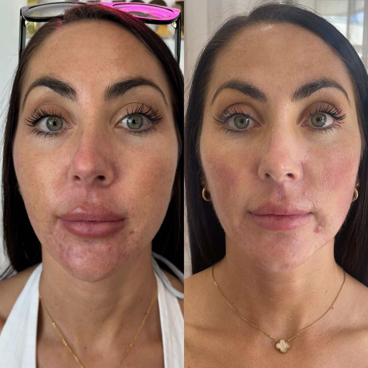 LIFT Brighten &amp; Tighten Package